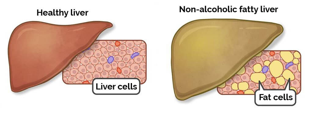 fatty liver disease image - Nash24x7