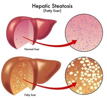 Fatty Liver Borders