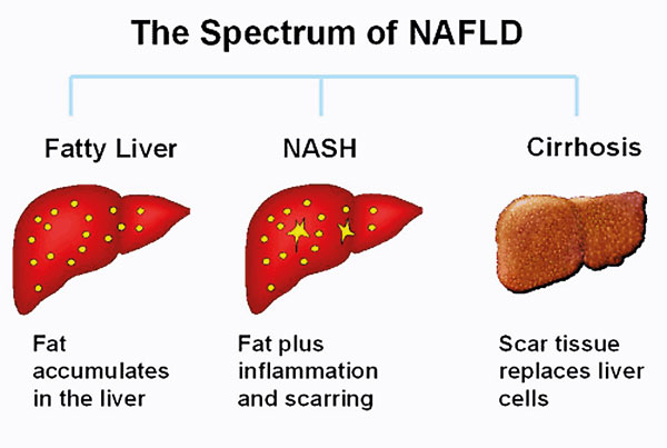 Fatty liver NASH Cirrhosis