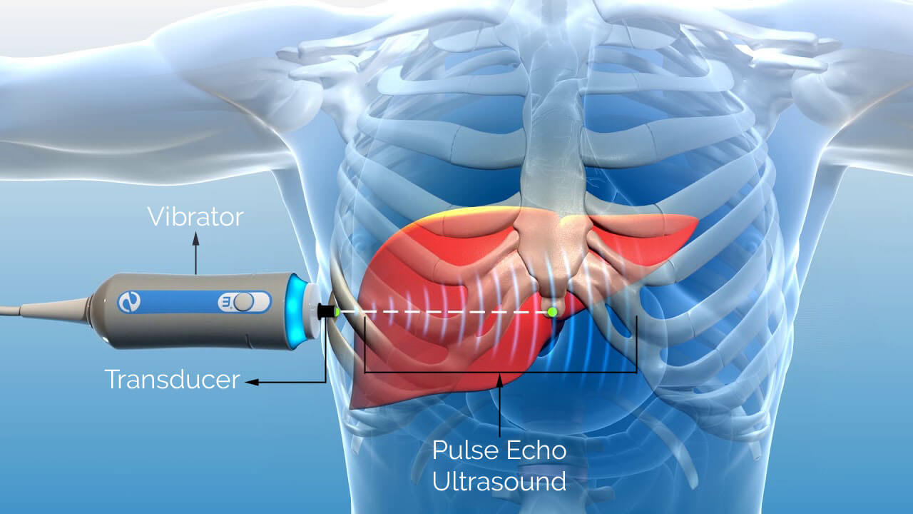 Fibroscan