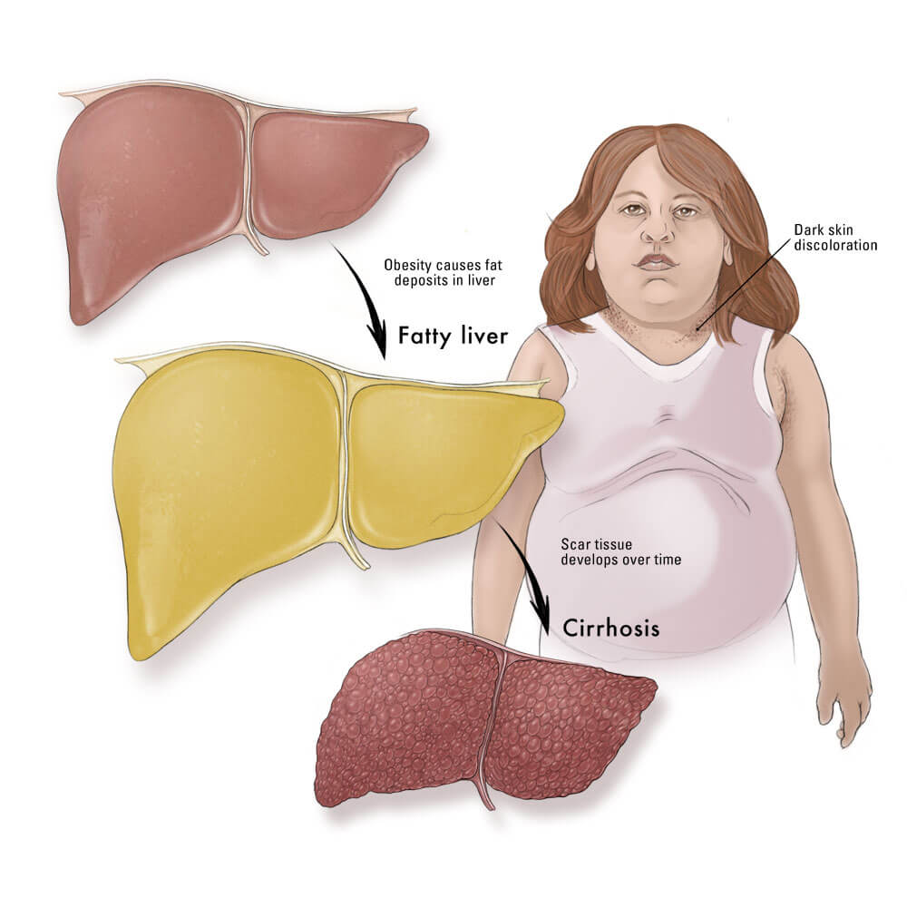 Why you should not delay diagnosis of NAFLD in kids
