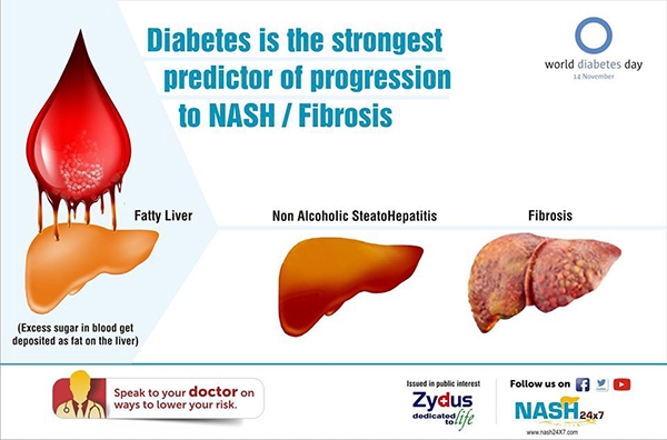 Diabetes is the strongest predictor of progression of NASH