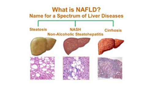 NAFLD 2