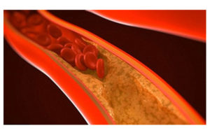 causes of nafld