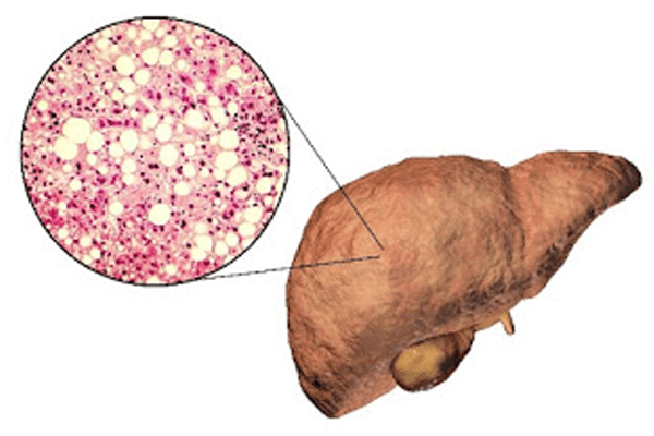 nonalcoholic fatty liver disease