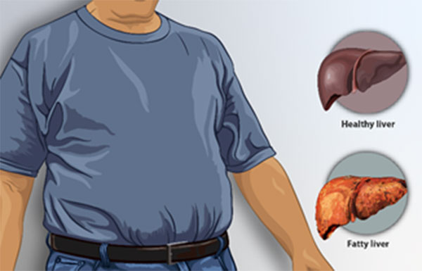 fat in liver