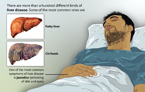 cirrhosis symptoms