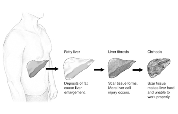 fat in liver causes