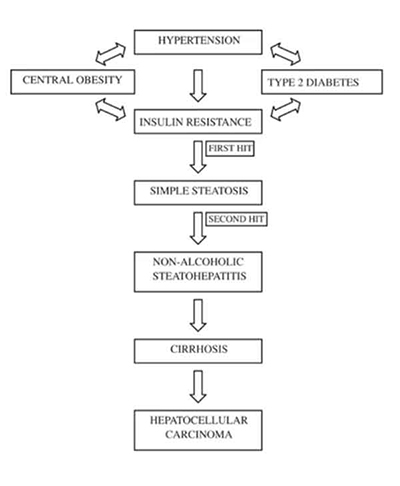 Fatty Liver Disease with Hypertension