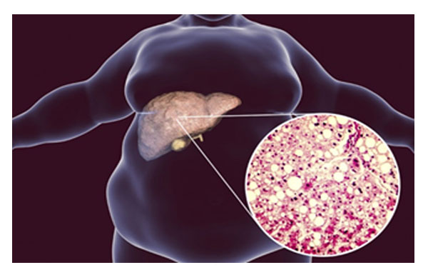 indications of fatty liver