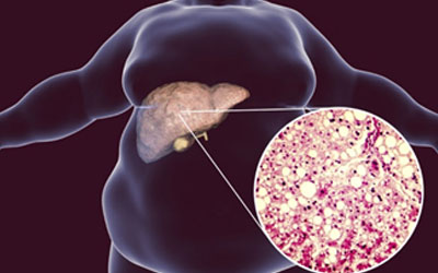 Indications of Fatty Liver