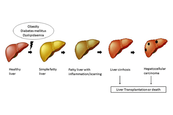 Cirrhosis and NAFLD