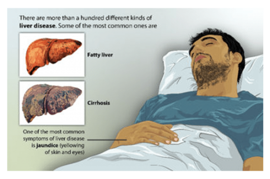 Liver Cirrhosis Symptoms Skin