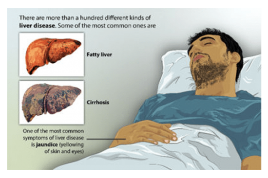 cirrhosis symptoms