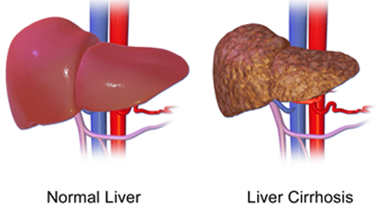 Liver Cirrhosis