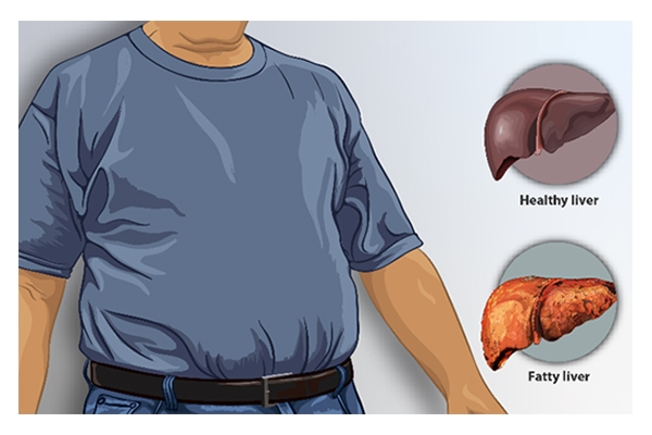 fat in liver