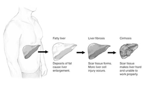 liver cancer and nafld