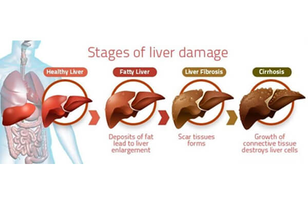 stages of liver damage