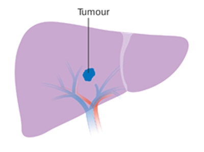 liver cancer-tumour
