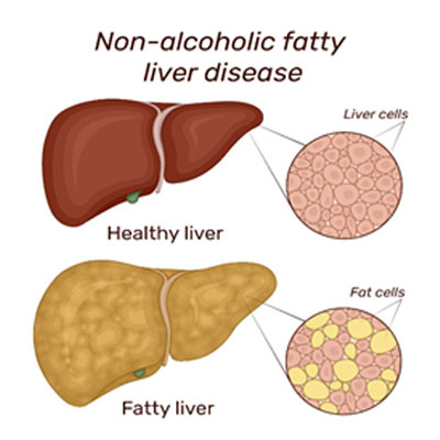 nonalcoholic steatohepatitis