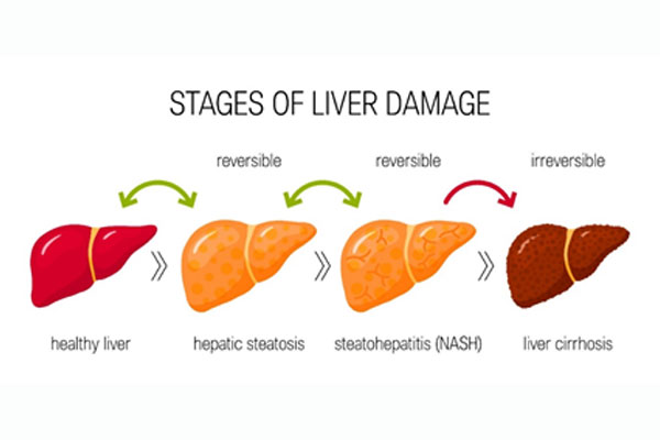 stages of liver damage
