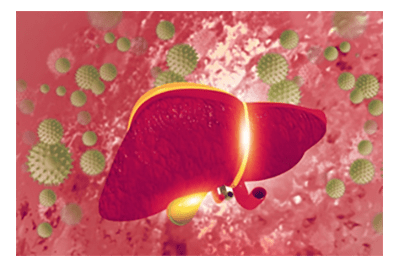 Cirrhosis causes and symptoms