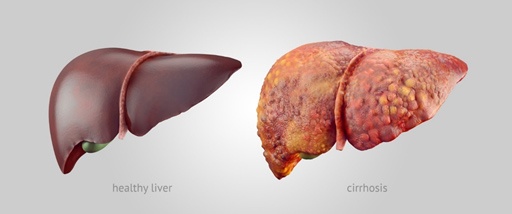 Cirrhosis of the Liver