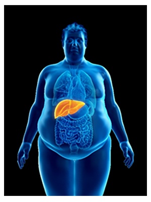 nafld