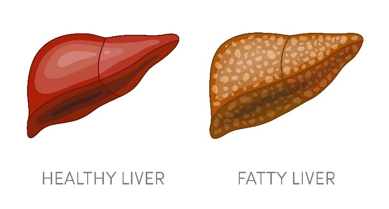Is There Any Cure for Nonalcoholic Steatohepatitis (Nash)? 