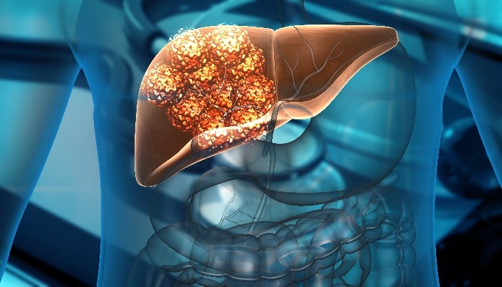 Is Nonalcoholic Steatohepatitis (NASH ) Life Threatening?