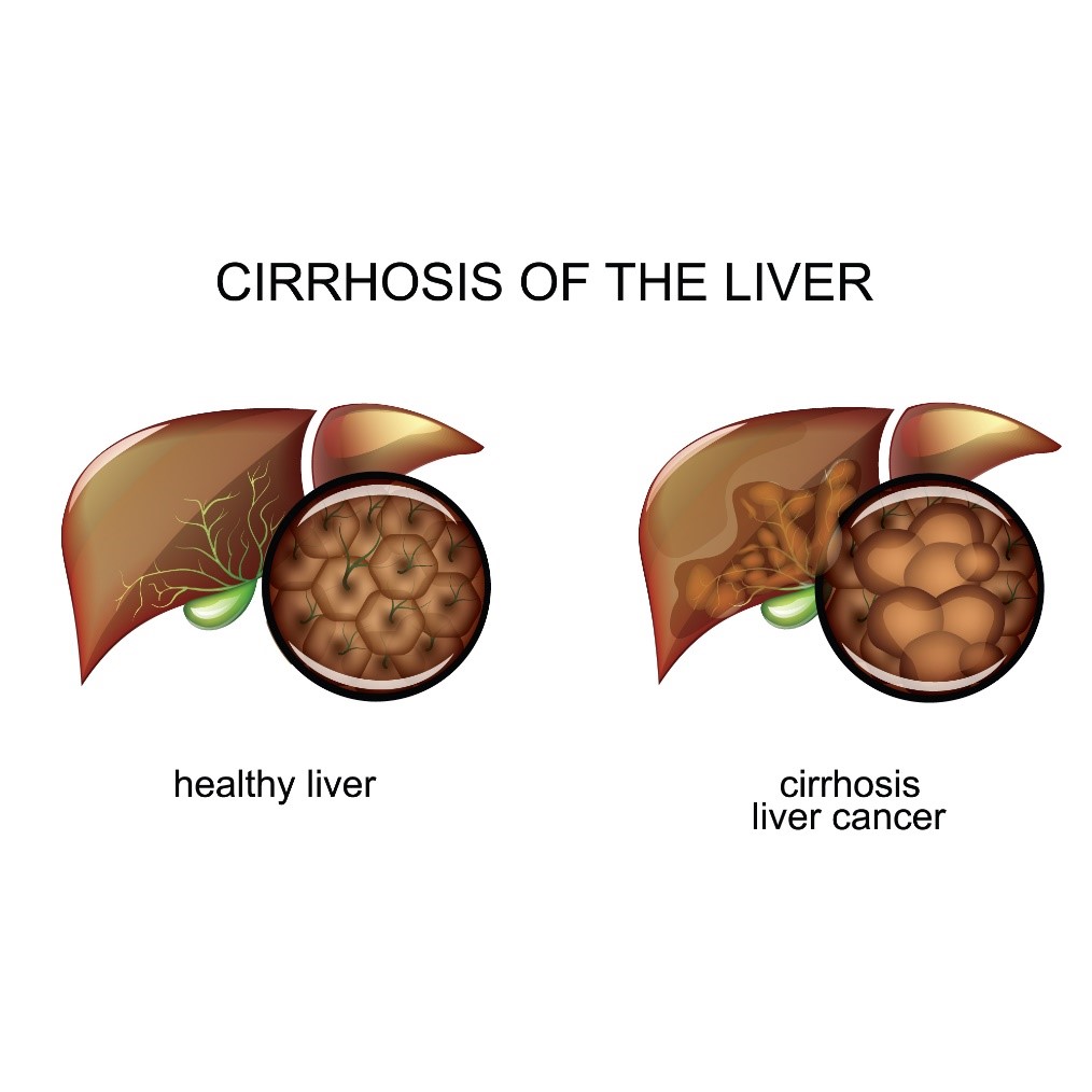 cirrhosis of the liver