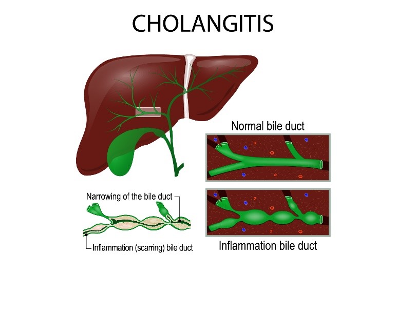 how biliary cirrhosis affects our lives