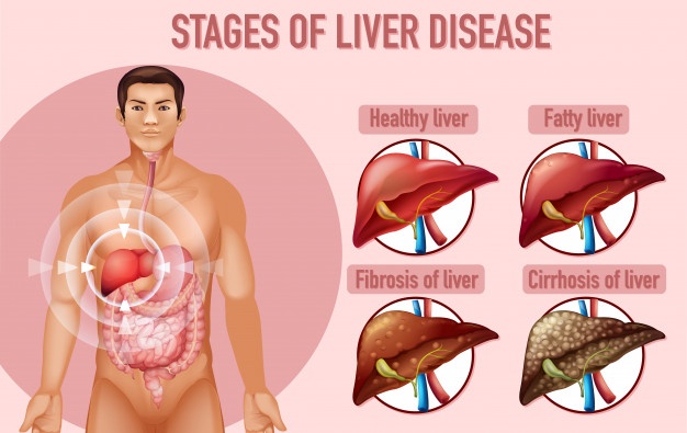 What-are-the-distinct-Liver-Cancer-Stages.jpg